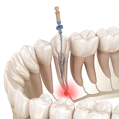 Endodontics for All Ages