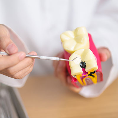 Cavities - Cause, preventives