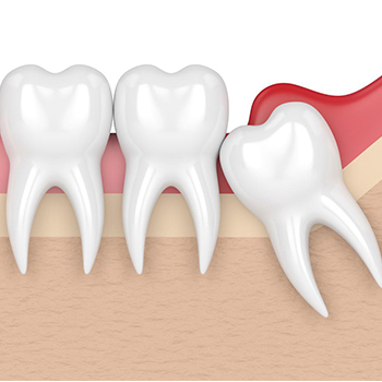 Wisdom Tooth Removal in Vijayawada
